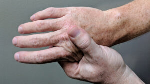Persona que se masajea la mano por dolor. Imagen ilustrativa.